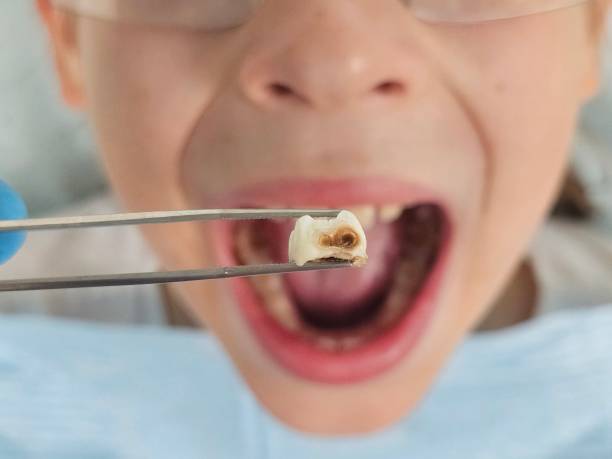Best Emergency Treatment for Toothache in Helemano, HI
